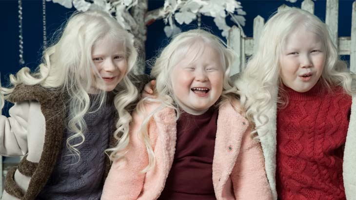 Кто такие альбиносы — симптомы и причины возникновения альбинизма